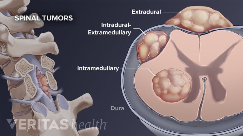 Tumors in different locations of the spine.